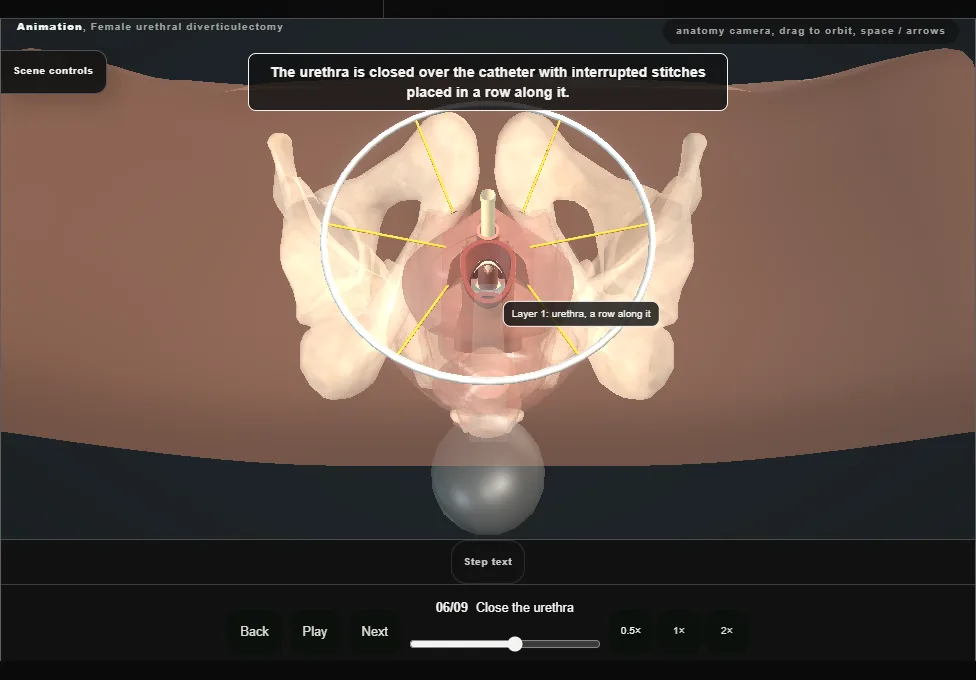 Female urethral diverticulectomy. Step 6: Close the urethra. Captured frame from the interactive animation.