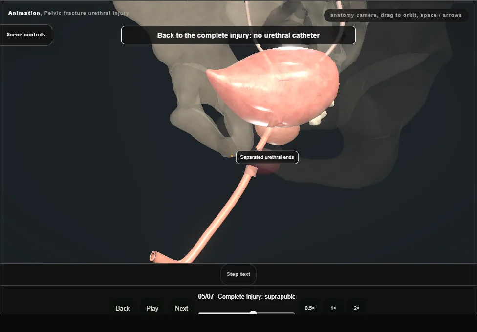 Pelvic fracture urethral injury. Step 5: Complete injury: suprapubic. Captured frame from the interactive animation.