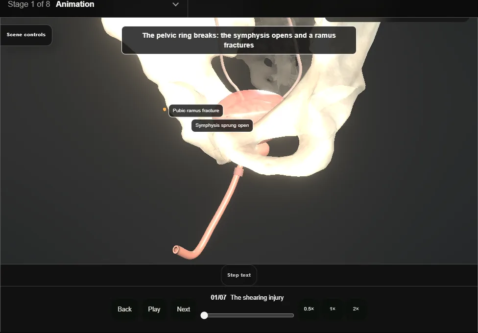 Pelvic fracture urethral injury. Step 1: The shearing injury. Captured frame from the interactive animation.