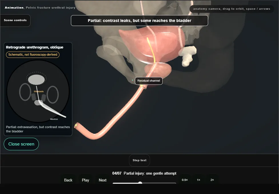 Pelvic fracture urethral injury. Step 4: Partial injury: one gentle attempt. Captured frame from the interactive animation.
