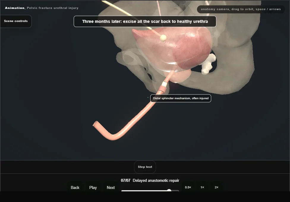 Pelvic fracture urethral injury. Step 7: Delayed anastomotic repair. Captured frame from the interactive animation.