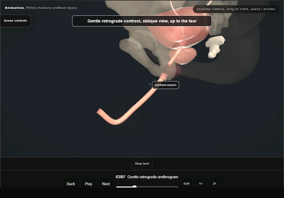 Pelvic fracture urethral injury. Step 3: Gentle retrograde urethrogram. Captured frame from the interactive animation.