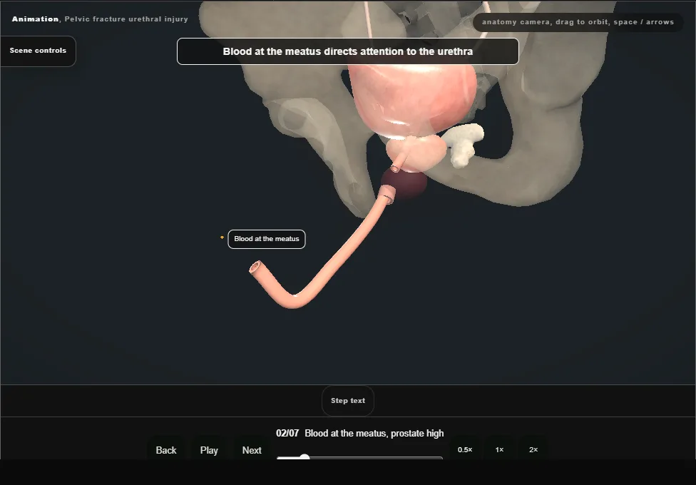 Pelvic fracture urethral injury. Step 2: Blood at the meatus, prostate high. Captured frame from the interactive animation.