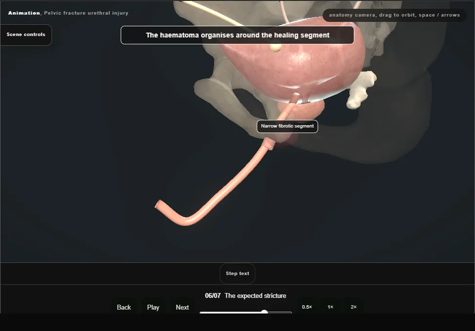 Pelvic fracture urethral injury. Step 6: The expected stricture. Captured frame from the interactive animation.