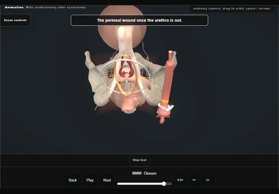 Male urethrectomy after cystectomy. Step 9: Closure. Captured frame from the interactive animation.
