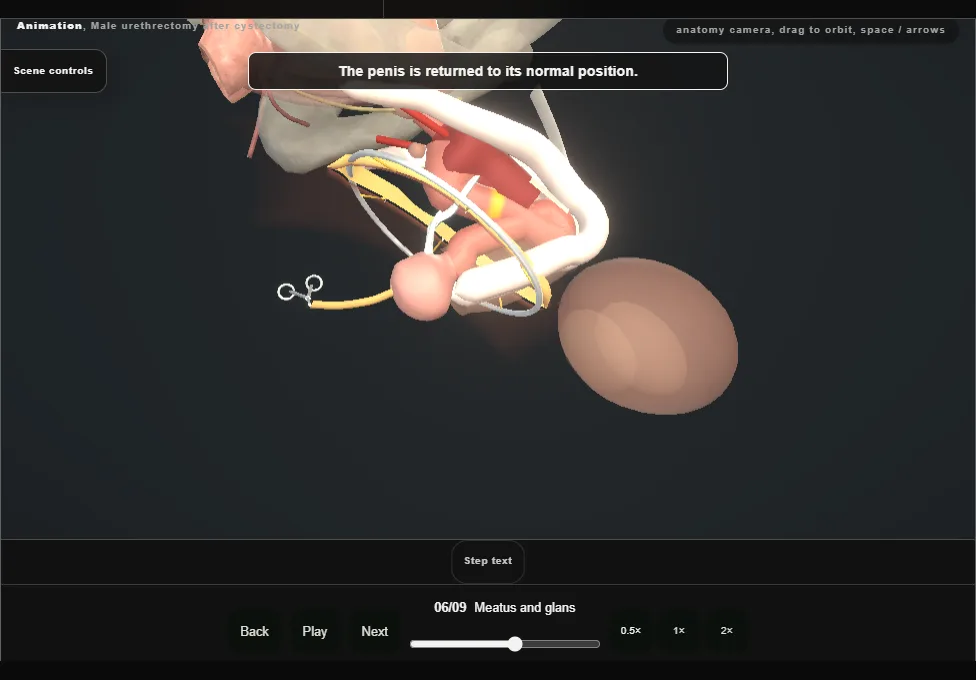 Male urethrectomy after cystectomy. Step 6: Meatus and glans. Captured frame from the interactive animation.