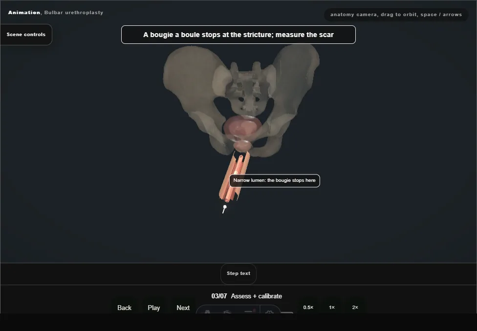 Bulbar urethroplasty. Step 3: Assess + calibrate. Captured frame from the interactive animation.