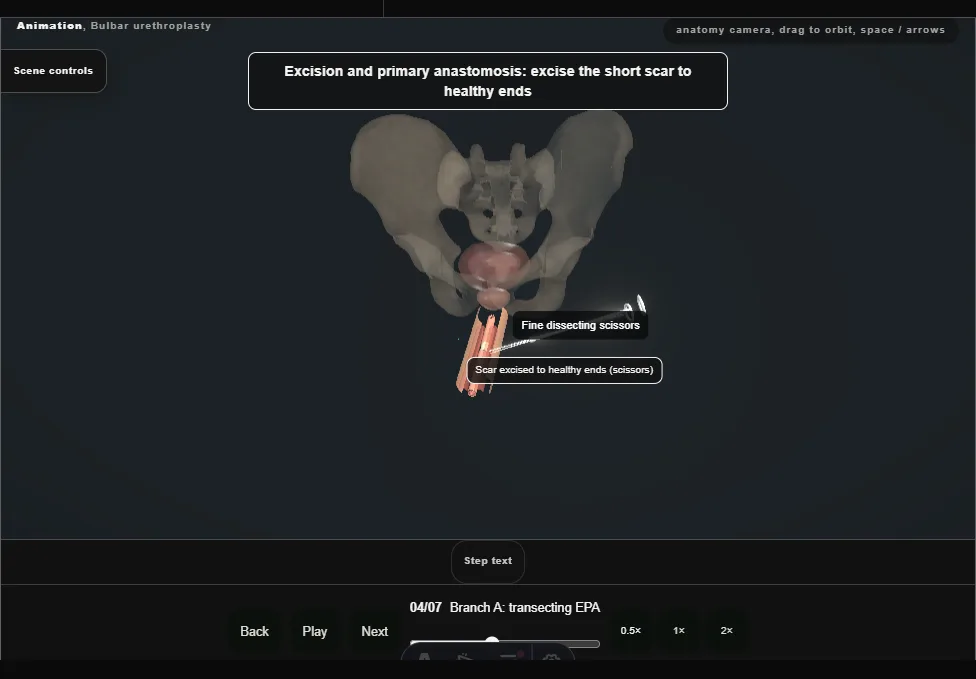Bulbar urethroplasty. Step 4: Branch A: transecting EPA. Captured frame from the interactive animation.