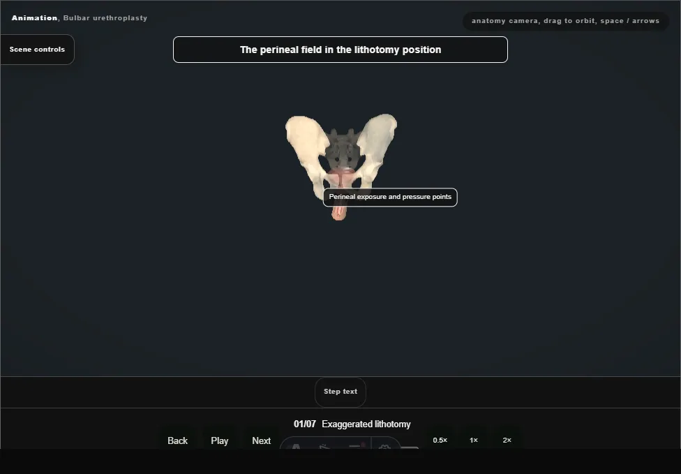 Bulbar urethroplasty. Step 1: Exaggerated lithotomy. Captured frame from the interactive animation.