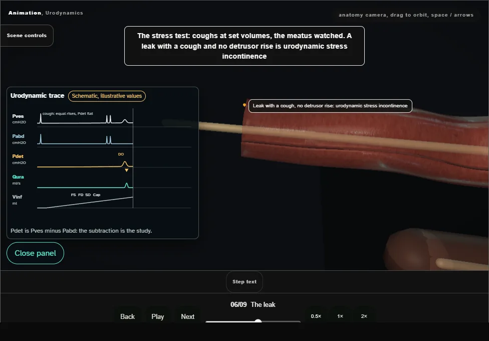 Urodynamics. Step 6: The leak. Captured frame from the interactive animation.