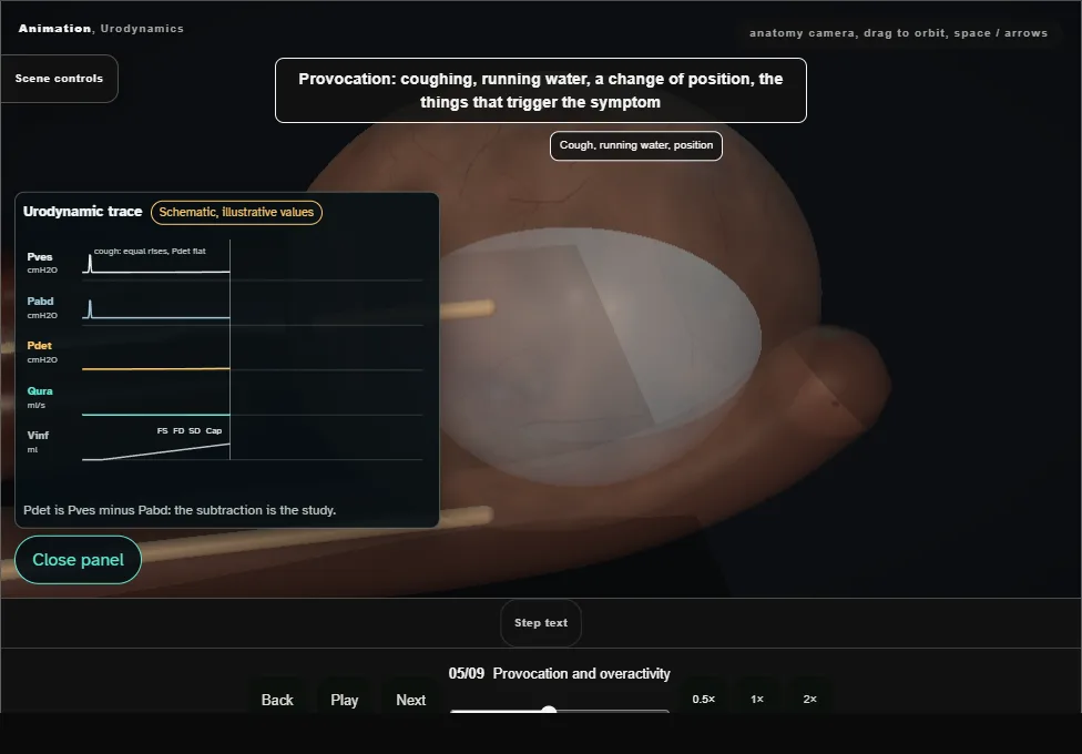 Urodynamics. Step 5: Provocation and overactivity. Captured frame from the interactive animation.