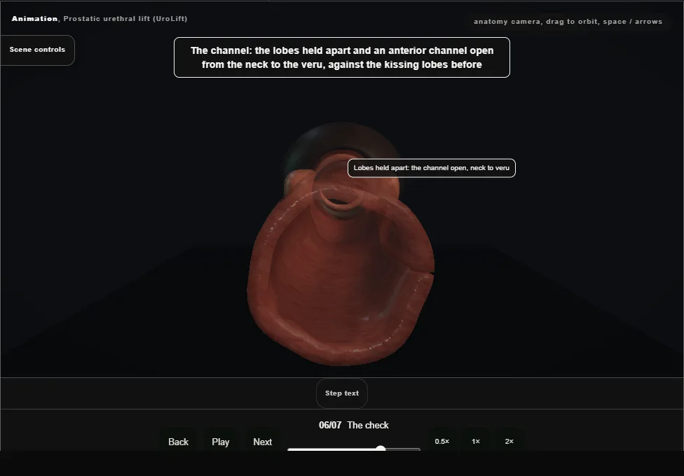 Prostatic urethral lift (UroLift). Step 6: The check. Captured frame from the interactive animation.
