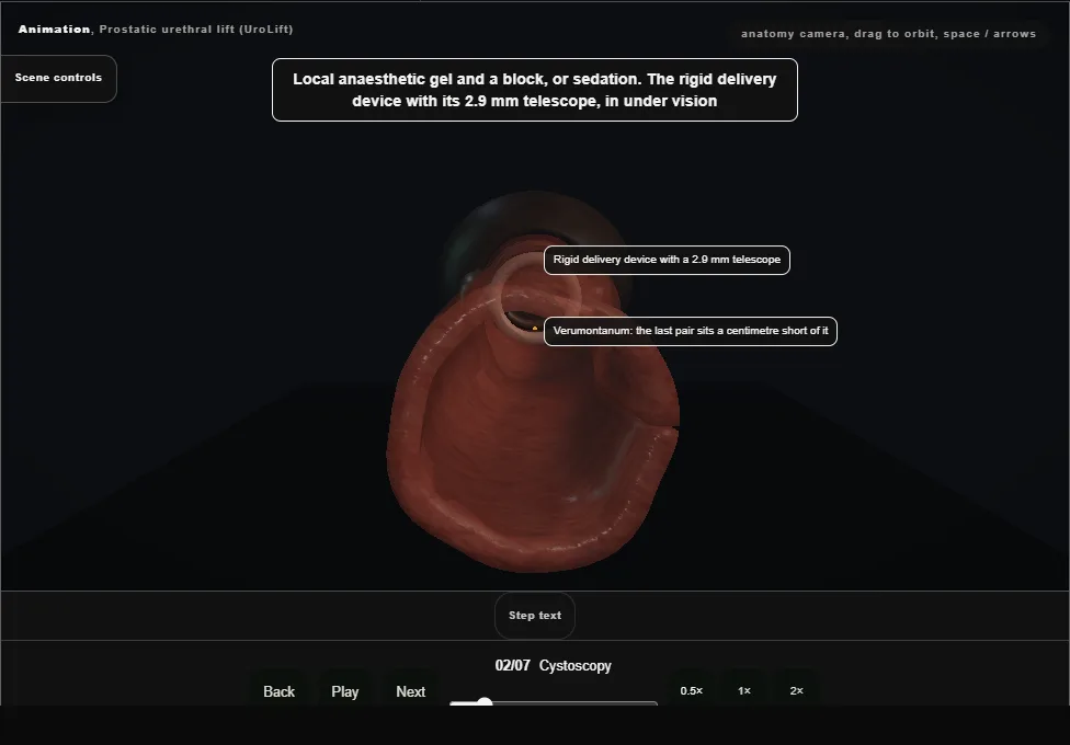 Prostatic urethral lift (UroLift). Step 2: Cystoscopy. Captured frame from the interactive animation.