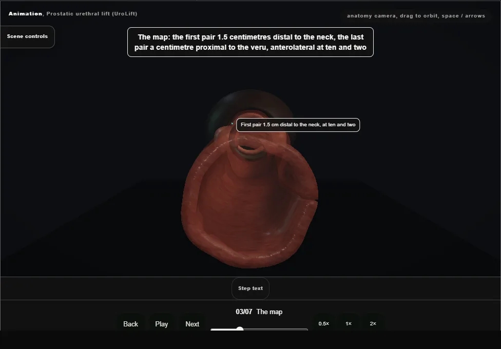 Prostatic urethral lift (UroLift). Step 3: The map. Captured frame from the interactive animation.