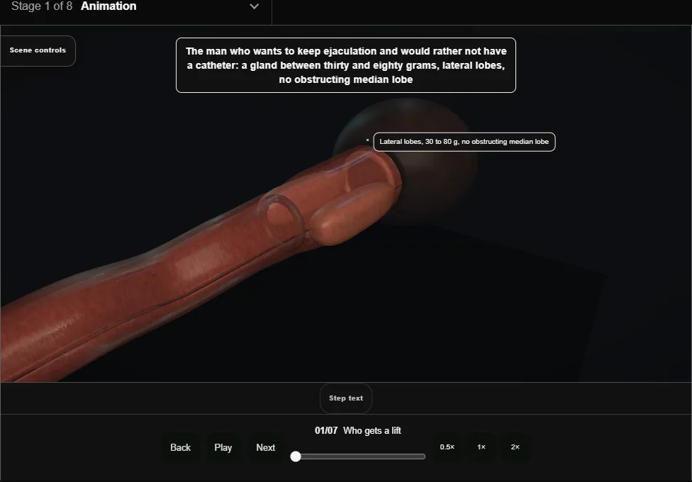 Prostatic urethral lift (UroLift). Step 1: Who gets a lift. Captured frame from the interactive animation.
