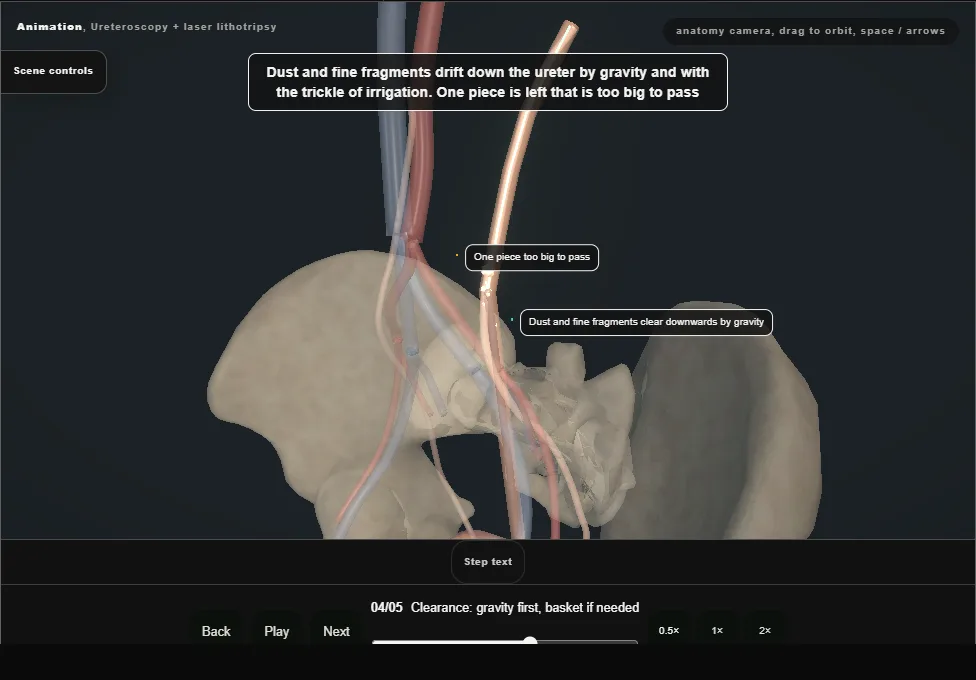 Ureteroscopy + laser lithotripsy. Step 4: Clearance: gravity first, basket if needed. Captured frame from the interactive animation.