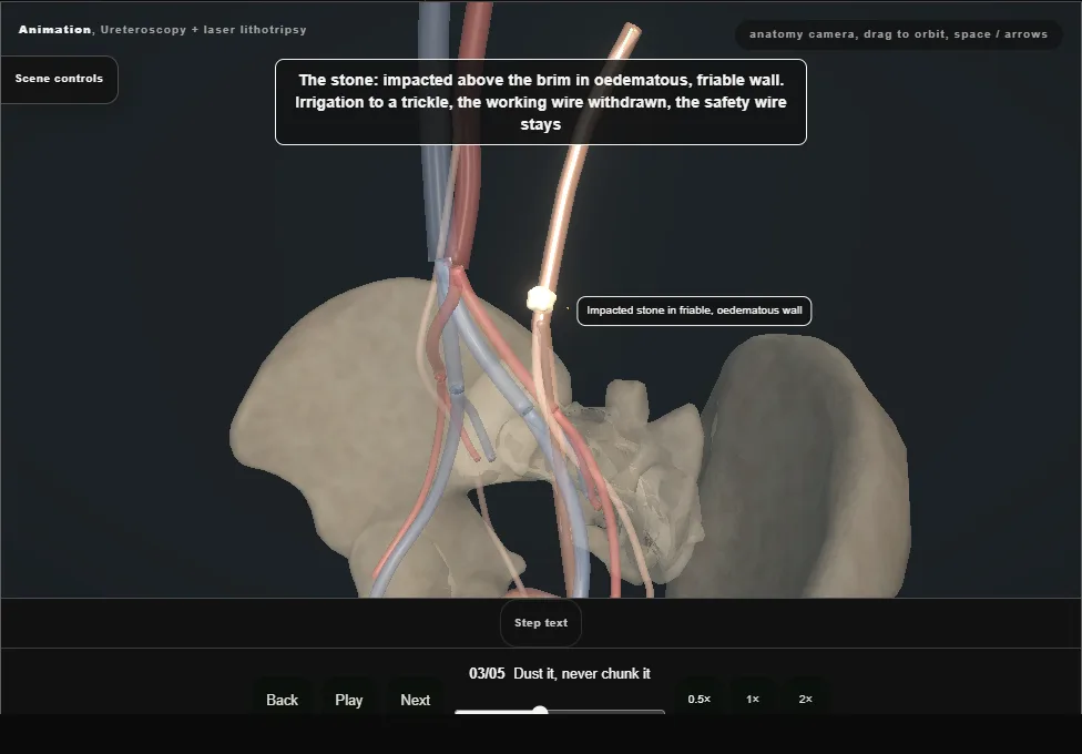 Ureteroscopy + laser lithotripsy. Step 3: Dust it, never chunk it. Captured frame from the interactive animation.