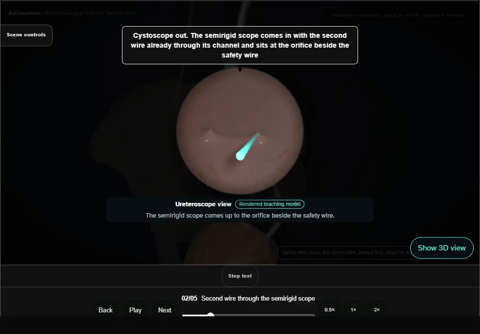 Ureteroscopy + laser lithotripsy. Step 2: Second wire through the semirigid scope. Captured frame from the interactive animation.