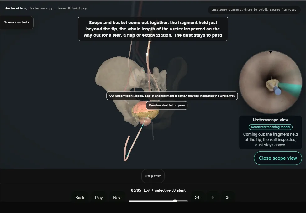 Ureteroscopy + laser lithotripsy. Step 5: Exit + selective JJ stent. Captured frame from the interactive animation.