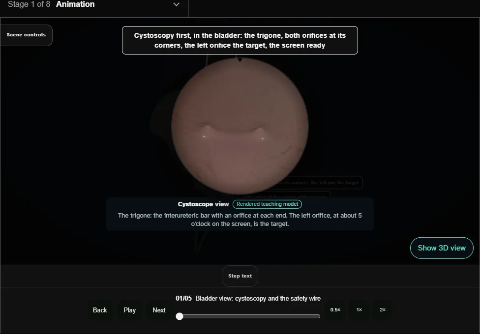 Ureteroscopy + laser lithotripsy. Step 1: Bladder view: cystoscopy and the safety wire. Captured frame from the interactive animation.