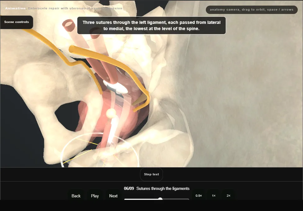 Enterocele repair with uterosacral vault suspension. Step 6: Sutures through the ligaments. Captured frame from the interactive animation.