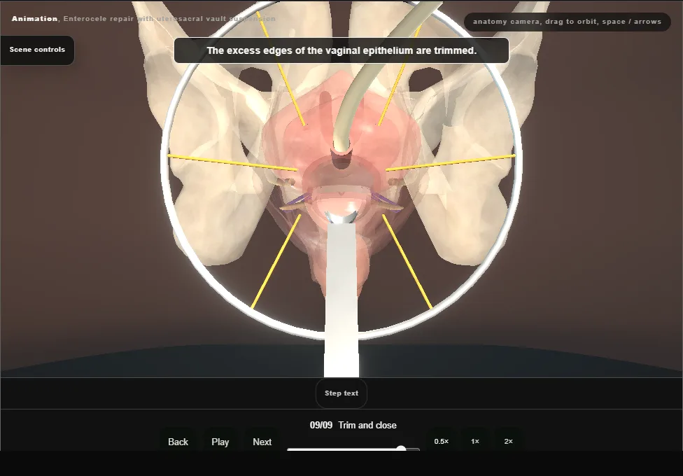 Enterocele repair with uterosacral vault suspension. Step 9: Trim and close. Captured frame from the interactive animation.