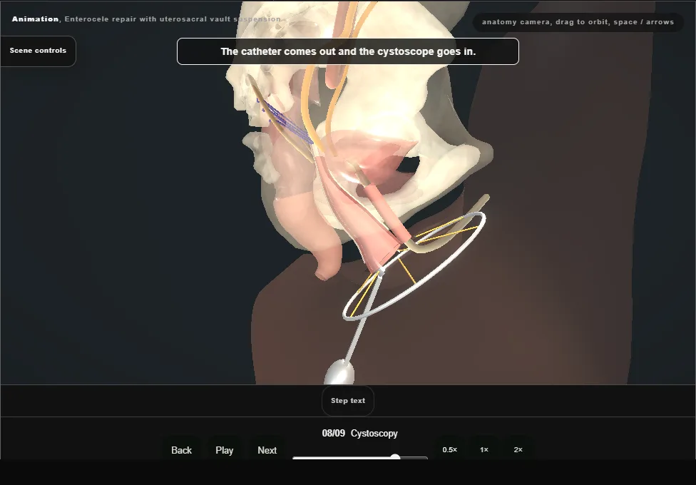 Enterocele repair with uterosacral vault suspension. Step 8: Cystoscopy. Captured frame from the interactive animation.