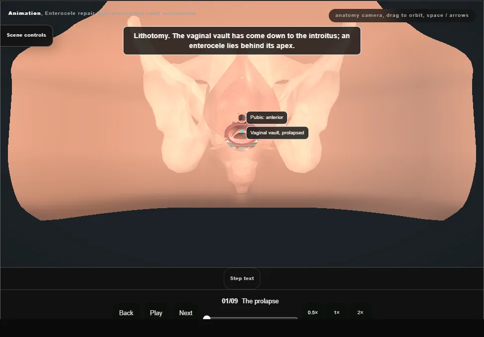 Enterocele repair with uterosacral vault suspension. Step 1: The prolapse. Captured frame from the interactive animation.
