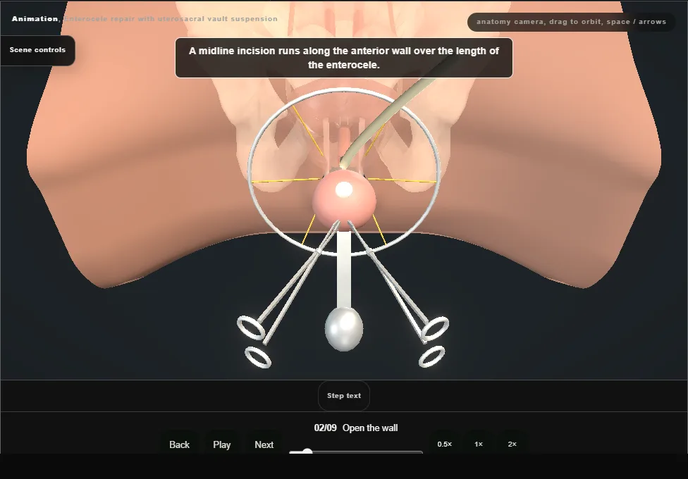 Enterocele repair with uterosacral vault suspension. Step 2: Open the wall. Captured frame from the interactive animation.