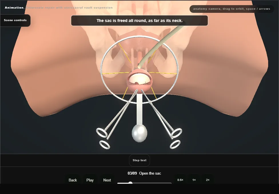 Enterocele repair with uterosacral vault suspension. Step 3: Open the sac. Captured frame from the interactive animation.