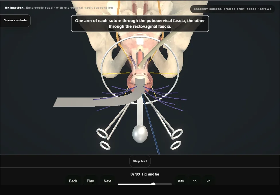Enterocele repair with uterosacral vault suspension. Step 7: Fix and tie. Captured frame from the interactive animation.
