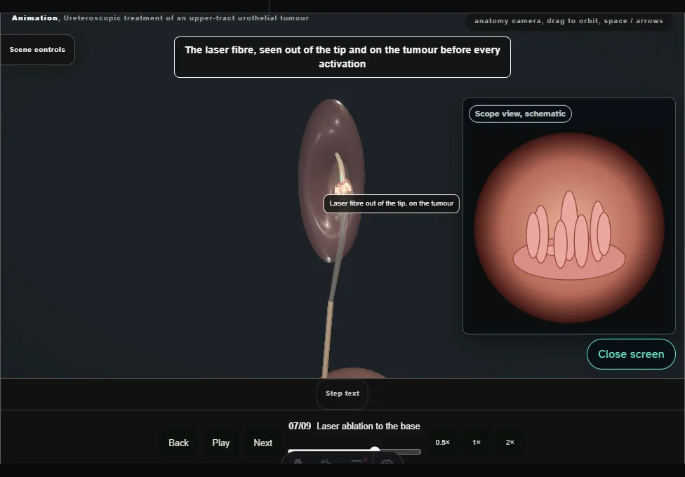 Ureteroscopic treatment of an upper-tract urothelial tumour. Step 7: Laser ablation to the base. Captured frame from the interactive animation.