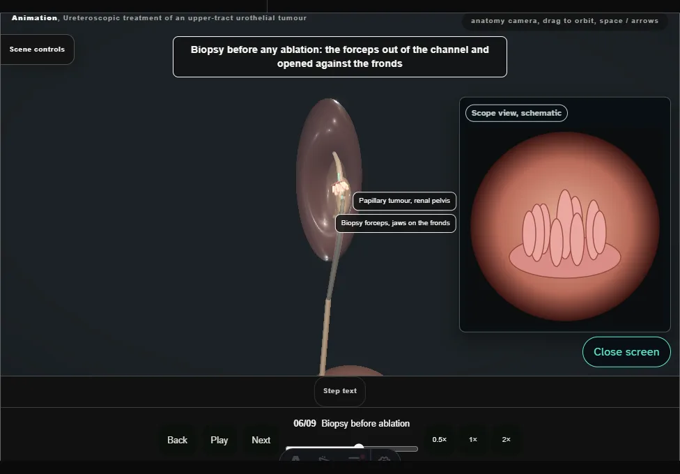 Ureteroscopic treatment of an upper-tract urothelial tumour. Step 6: Biopsy before ablation. Captured frame from the interactive animation.