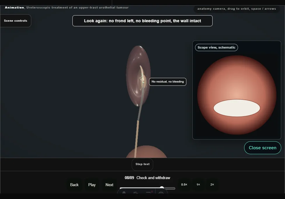 Ureteroscopic treatment of an upper-tract urothelial tumour. Step 8: Check and withdraw. Captured frame from the interactive animation.
