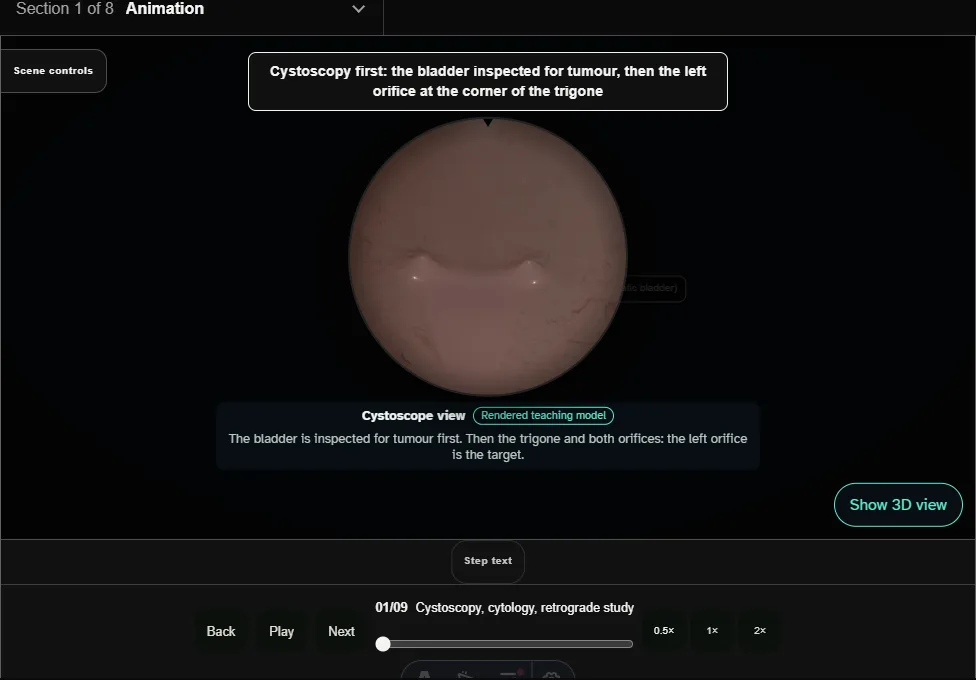 Ureteroscopic treatment of an upper-tract urothelial tumour. Step 1: Cystoscopy, cytology, retrograde study. Captured frame from the interactive animation.