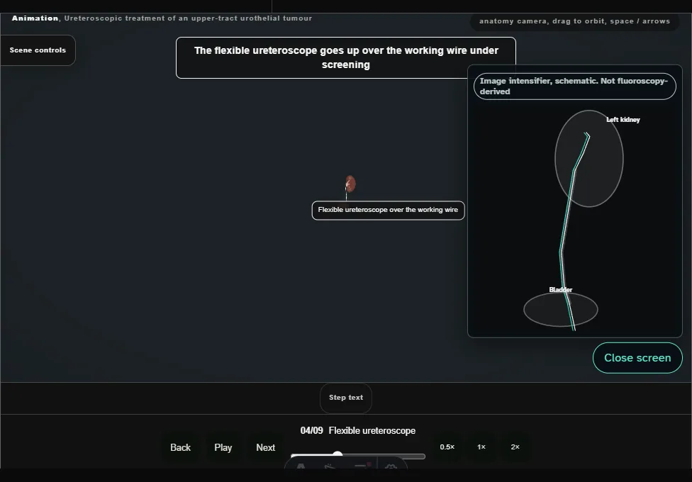 Ureteroscopic treatment of an upper-tract urothelial tumour. Step 4: Flexible ureteroscope. Captured frame from the interactive animation.