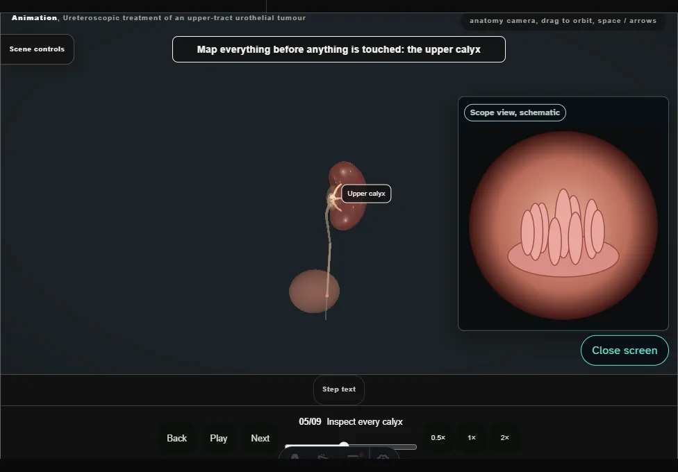 Ureteroscopic treatment of an upper-tract urothelial tumour. Step 5: Inspect every calyx. Captured frame from the interactive animation.