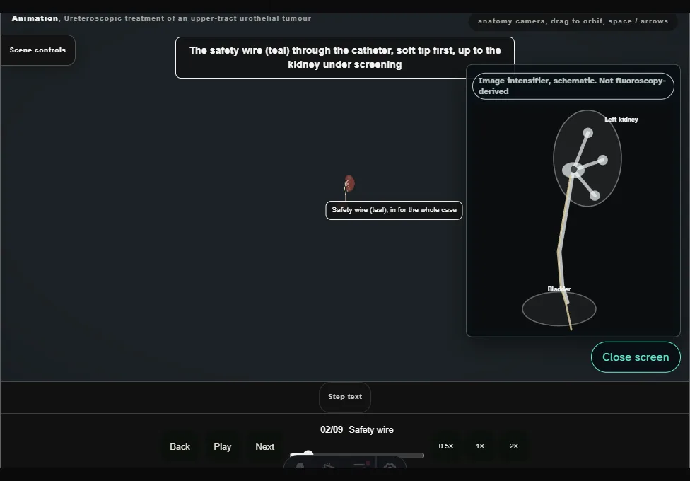 Ureteroscopic treatment of an upper-tract urothelial tumour. Step 2: Safety wire. Captured frame from the interactive animation.