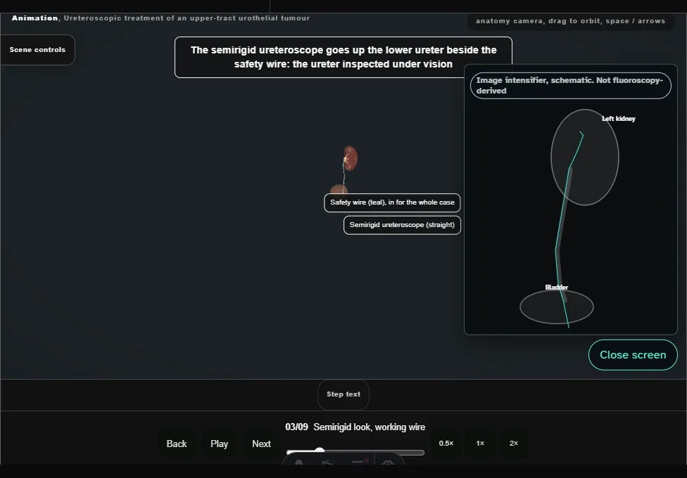 Ureteroscopic treatment of an upper-tract urothelial tumour. Step 3: Semirigid look, working wire. Captured frame from the interactive animation.