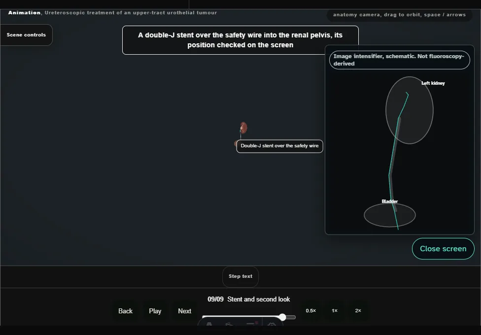 Ureteroscopic treatment of an upper-tract urothelial tumour. Step 9: Stent and second look. Captured frame from the interactive animation.