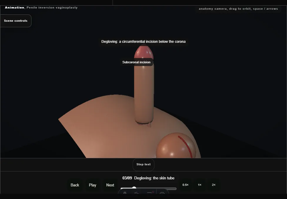 Penile inversion vaginoplasty. Step 3: Degloving: the skin tube. Captured frame from the interactive animation.