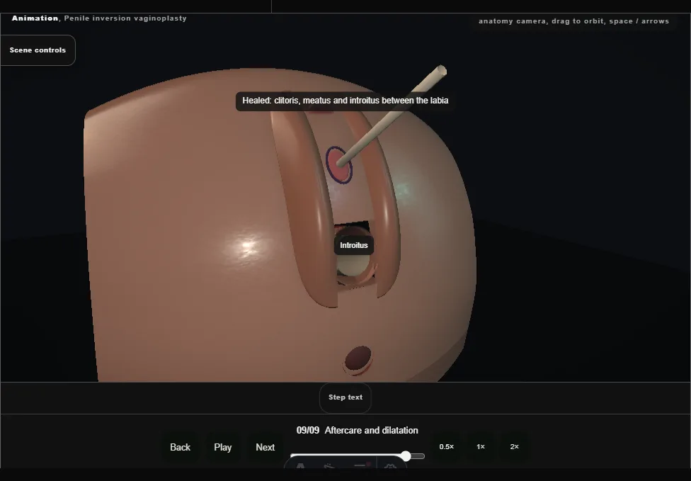 Penile inversion vaginoplasty. Step 9: Aftercare and dilatation. Captured frame from the interactive animation.