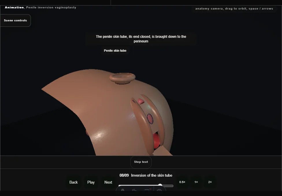 Penile inversion vaginoplasty. Step 8: Inversion of the skin tube. Captured frame from the interactive animation.