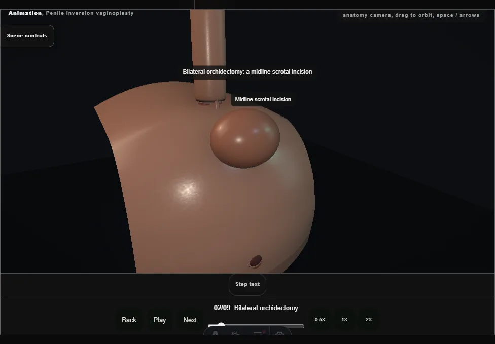 Penile inversion vaginoplasty. Step 2: Bilateral orchidectomy. Captured frame from the interactive animation.