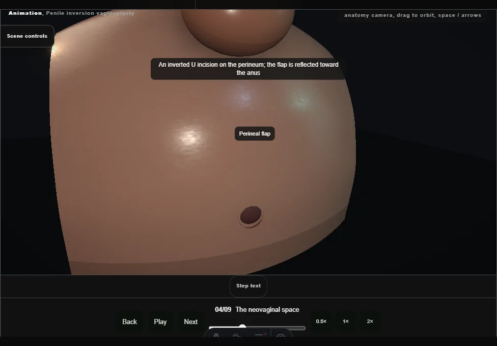 Penile inversion vaginoplasty. Step 4: The neovaginal space. Captured frame from the interactive animation.