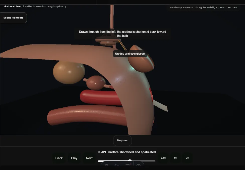 Penile inversion vaginoplasty. Step 6: Urethra shortened and spatulated. Captured frame from the interactive animation.
