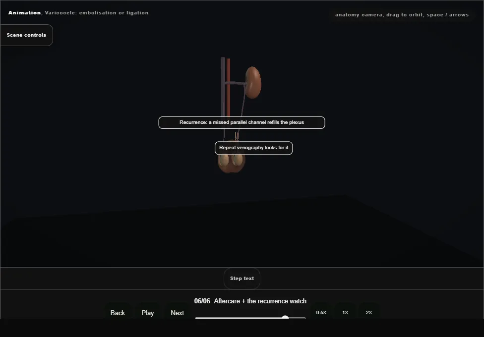 Varicocele: embolisation or ligation. Step 6: Aftercare + the recurrence watch. Captured frame from the interactive animation.