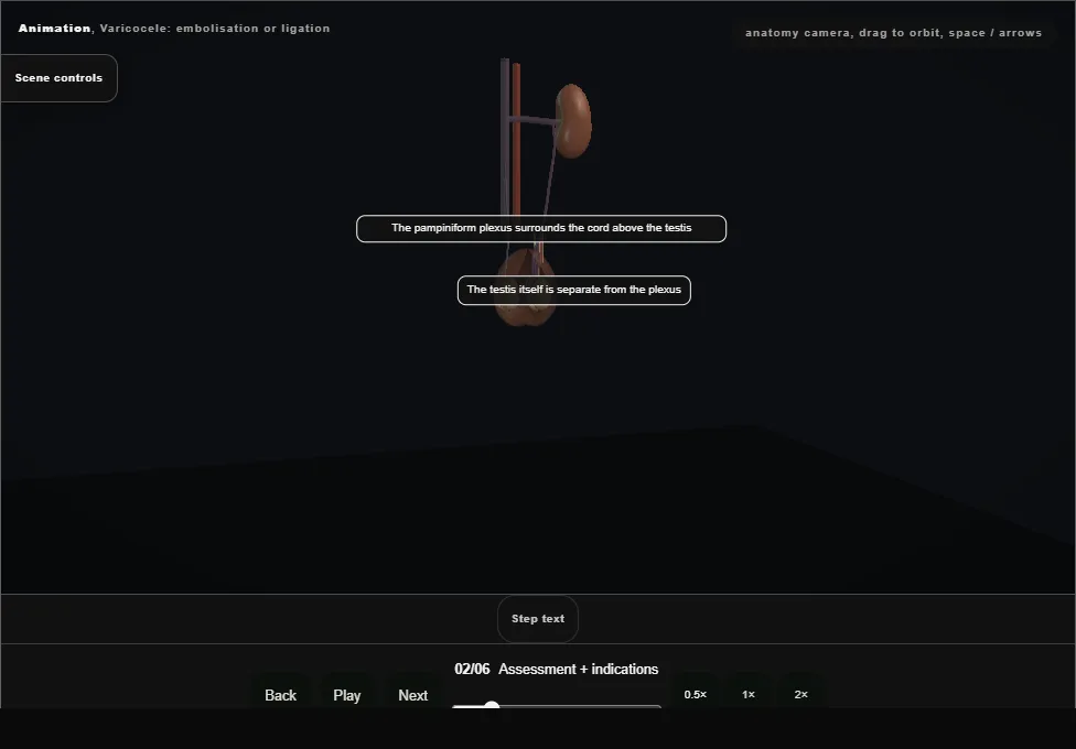 Varicocele: embolisation or ligation. Step 2: Assessment + indications. Captured frame from the interactive animation.