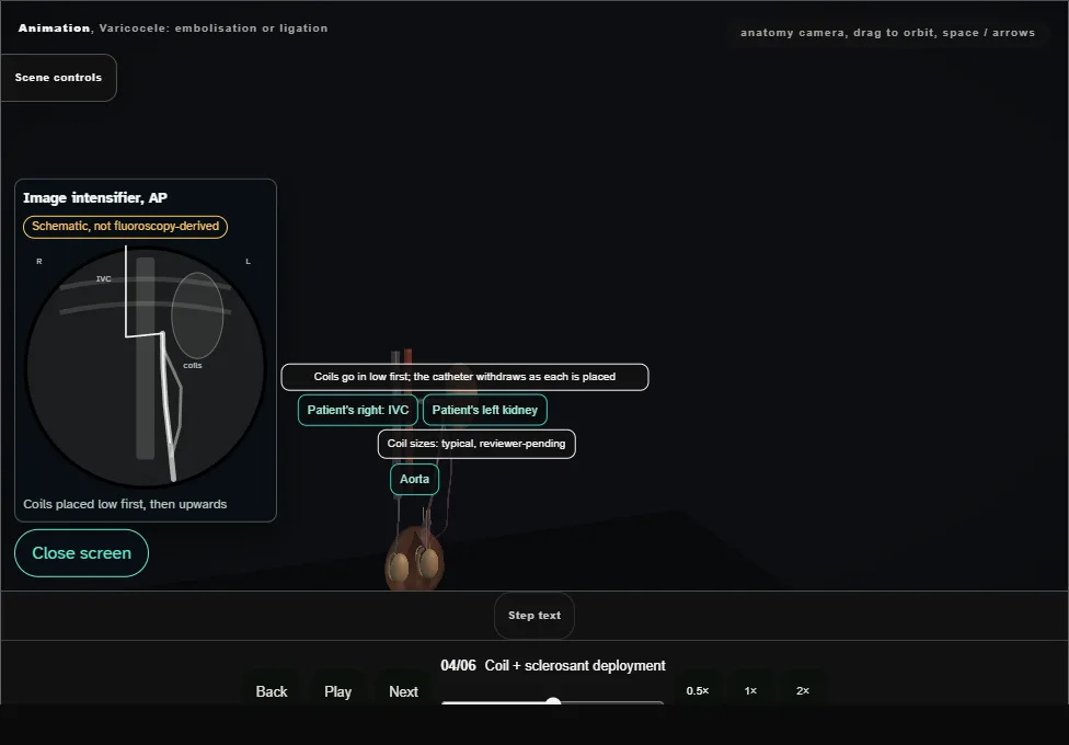 Varicocele: embolisation or ligation. Step 4: Coil + sclerosant deployment. Captured frame from the interactive animation.