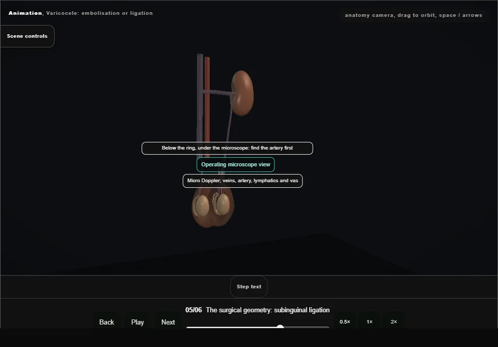 Varicocele: embolisation or ligation. Step 5: The surgical geometry: subinguinal ligation. Captured frame from the interactive animation.